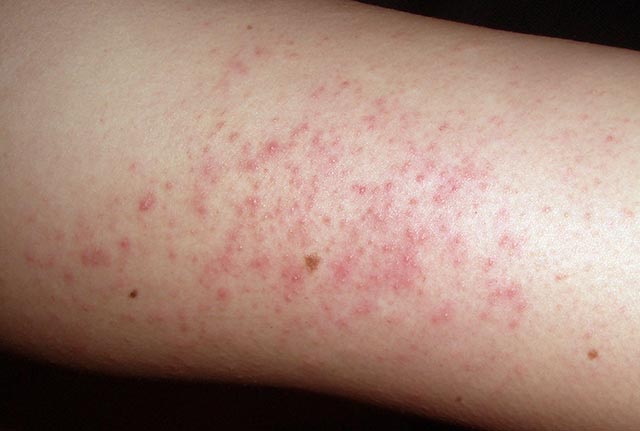 időskori bőrbetegségek képekkel piros folt jelent meg a lábán, fáj