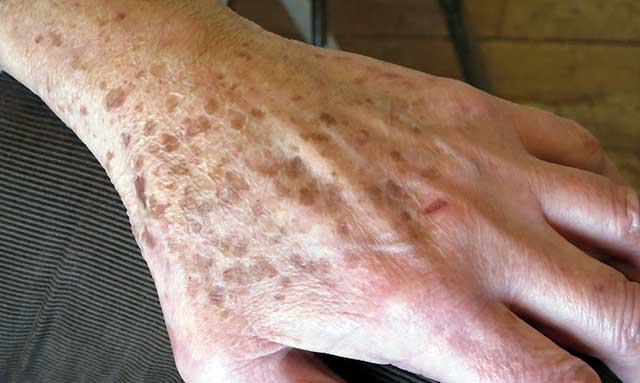 időskori bőrbetegségek képekkel