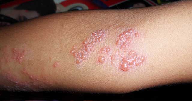 bőrbetegségek kiváltó okai
