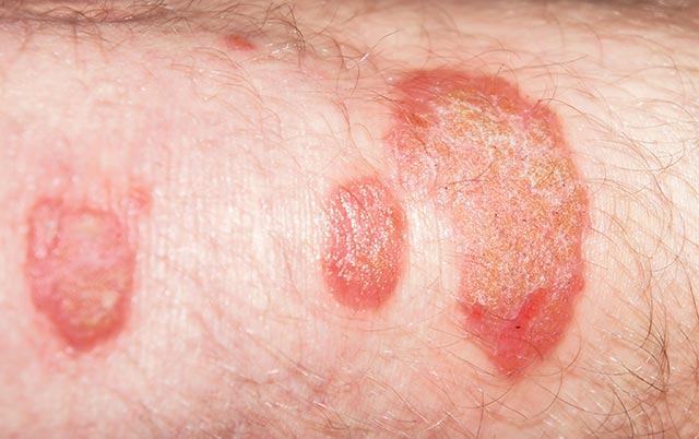 Fertőző bőrbetegségek kezelése