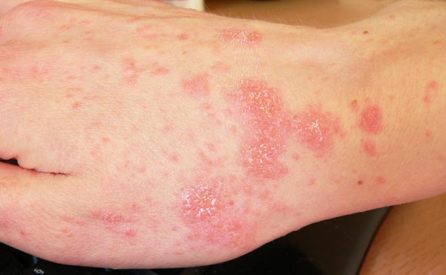 bőrbetegség a lábakon vörös foltok